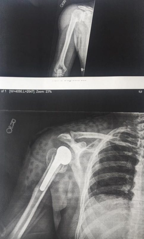 scott jacobs' shoulder surgery before and after